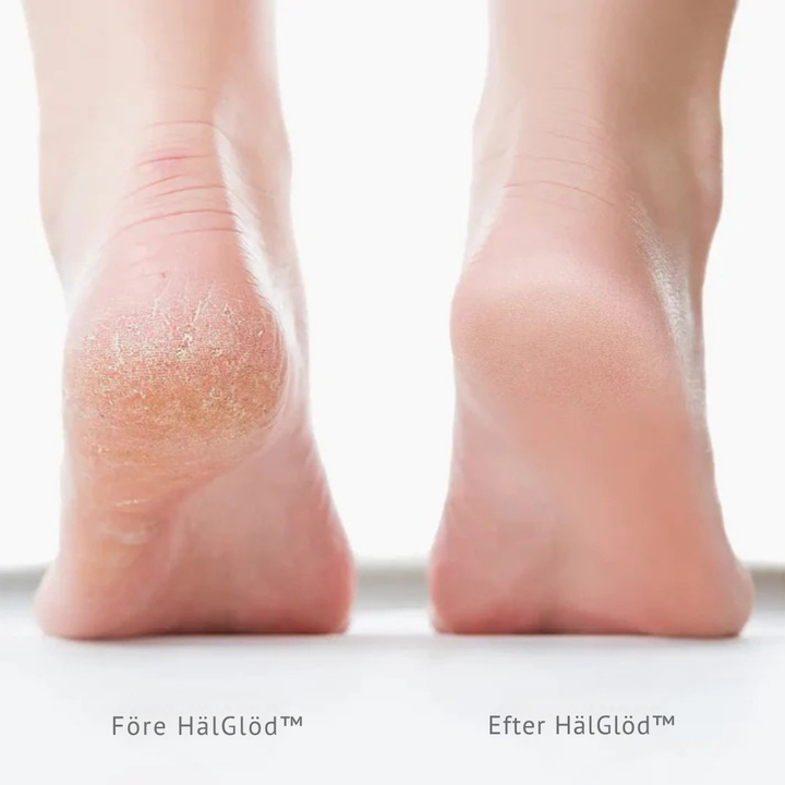 HälGlöd™ | Hälslip – Mot torra, spruckna hälar